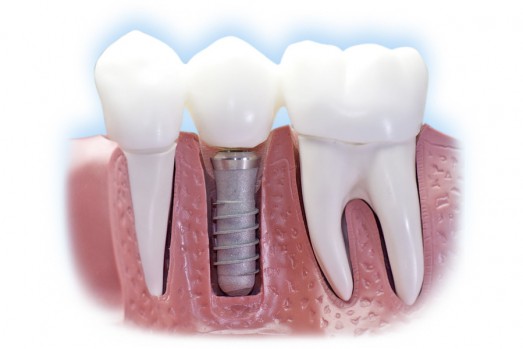 zubni implantati
