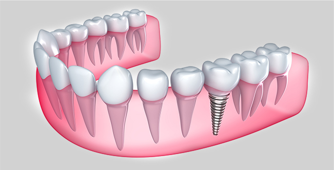 zubni implantati